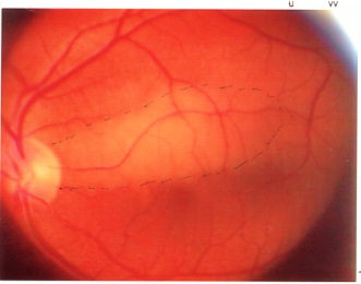 Occlusione arteria Cilioretinica dopo 15 anni